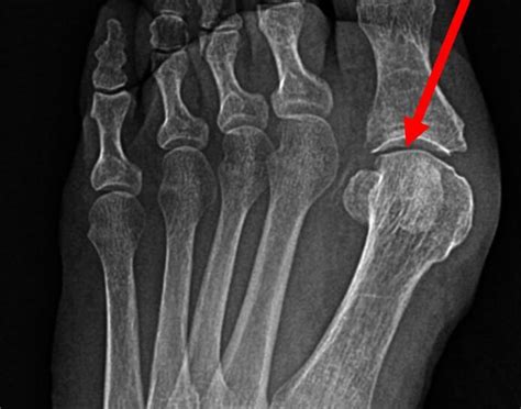 Sesamoid Bone Fracture