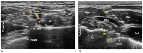 Cervical Plexus Ultrasound