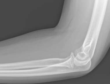 Coronoid Fracture Workup: Radiography, CT and MRI