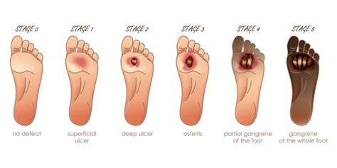 Diabetic Foot Ulcers- Symptoms, Causes, And Risk Factors - Pristyn Care