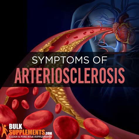 What is Arteriosclerosis: Symptoms, Causes & Treatment