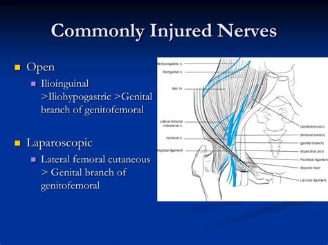 Ilioinguinal Nerve Inguinal Hernia