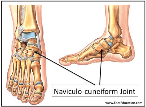 Naviculocuneiform Joint Fusion - FootEducation