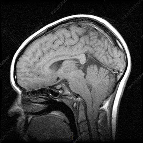 MRI of Severe Chiari I Malformation - Stock Image - C027/1659 - Science ...