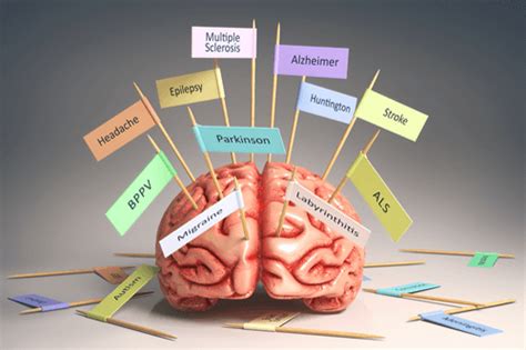 Huntington Disease:Overview, causes, symptoms, & management | FactDr