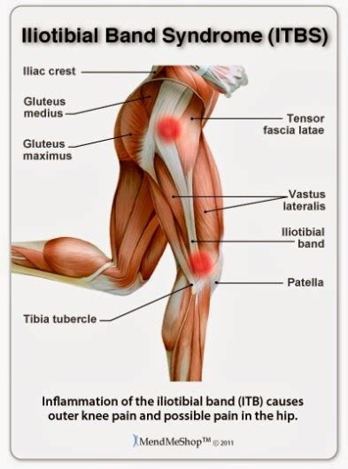 IT Band Syndrome - Arizona Orthopedic Physical Therapy