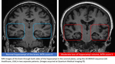 Dementia - Quantum Medical Imaging