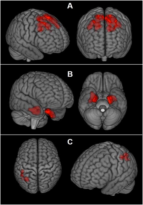 Brain scans may reveal concussion damage in living athletes - WHYY