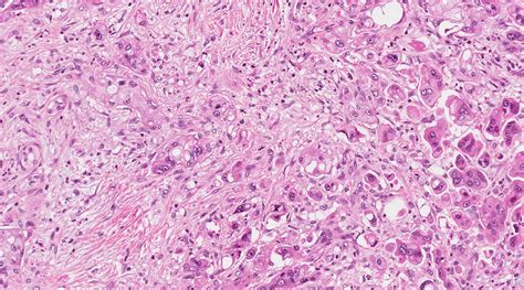 Pathology Outlines - Undifferentiated carcinoma