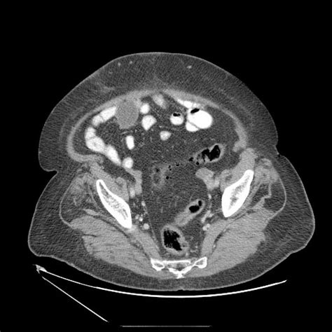 Mesenteric cyst - wikidoc