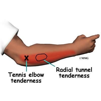 Tennis Elbow - eOrthopod.com