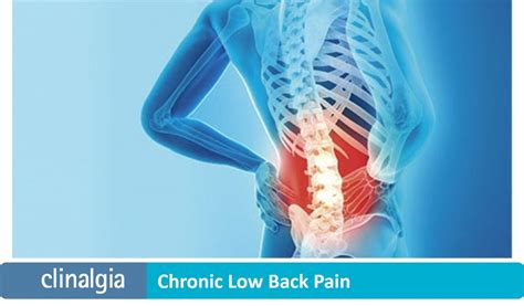 Chronic Low Back Pain | Origin and Treatment | Clinalgia