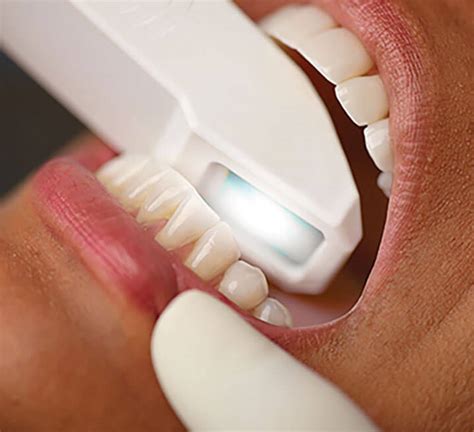 iTero scanner | Orthodontic treatment | Invisible Orthodontics