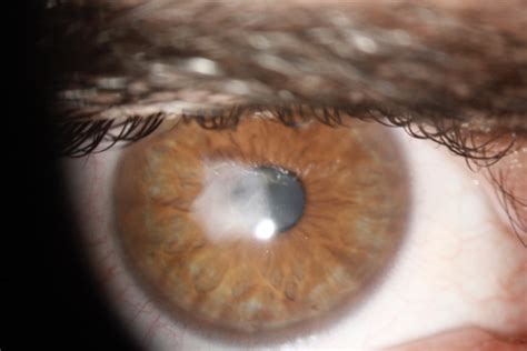 Corneal Scarring — QEI Laser · Laser Eye Surgery · Queensland Eye Institute · Brisbane