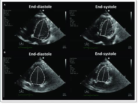 The calculation of left ventricular ejection fraction. Left ventricular... | Download Scientific ...