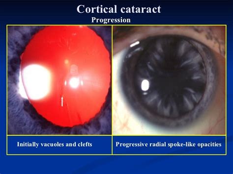 ophthalmology.Diseases of the lens.(dr.baxtyar)