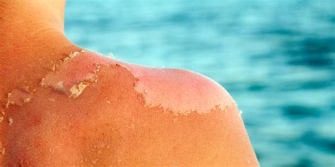 Sunburn Peeling - Why Sunburned Skin Peels & How to Stop It