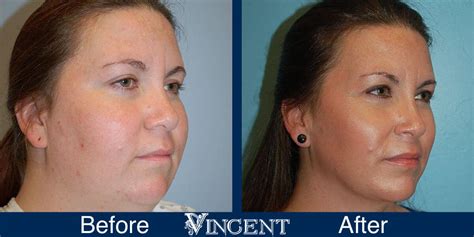 Vincent Surgical Arts | Submental Lipsosuction in Cottonwood Heights