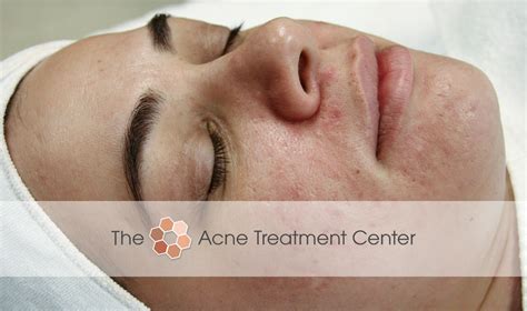 Inflamed Acne Treatment Photo | Acne Treatment Center | Portland OR ...