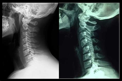 Rectificación cervical | Enrique García Ballesteros