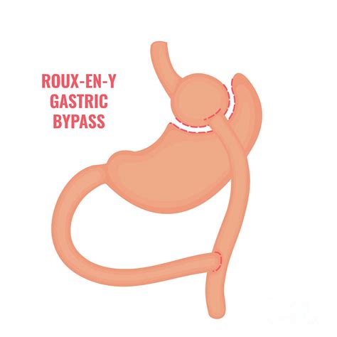 Roux-en-y Gastric Bypass Bariatric Surgery by Science Photo Library