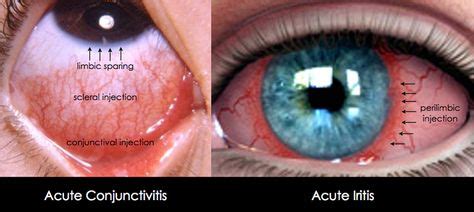 Conjunctivitis Bacterial: mucopurulent discharge, eyelids stuck together, rx: topical ABX Viral ...