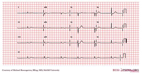 Junctional bradycardia EKG examples - wikidoc