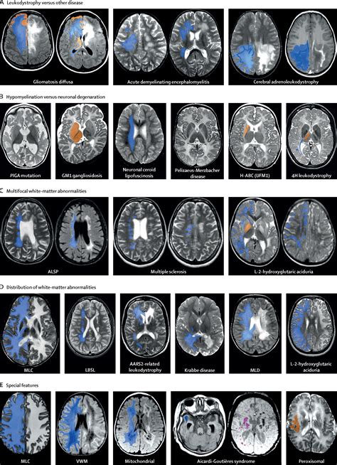 Diagnosis, prognosis, and treatment of leukodystrophies - The Lancet Neurology