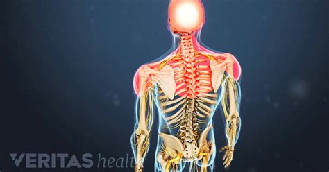 Cervical Osteoarthritis Symptoms