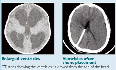 Hydrocephalus shunt komplikationer – Spegel med belysning