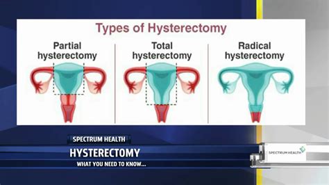 Recovery After Partial Hysterectomy