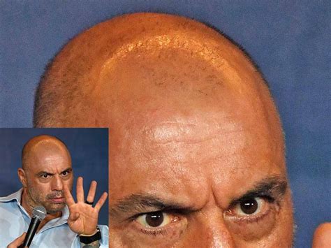 Joe Rogan Hair Transplant Failure! Here's what went wrong!