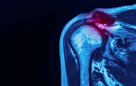 Don’t Wait! Is 2020 The Right Year For Shoulder Surgery? - Orthopedic ...