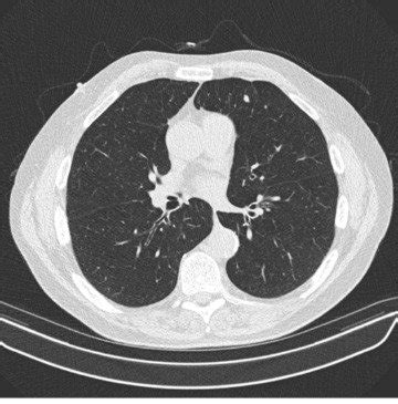 What You Need to Know About Lung Cancer Screenings