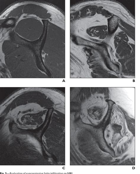 Supraspinatus Muscle Mri