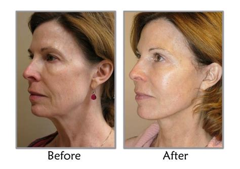 Discover the MACS Facelift Difference at Thompson Facial Plastics in SLC, UT