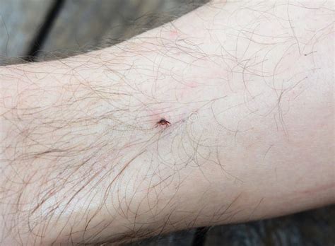 A Man Has a Deer or Black-legged Tick Bite, Ixodes Scapularis Bite on His Leg and Risks To Get ...