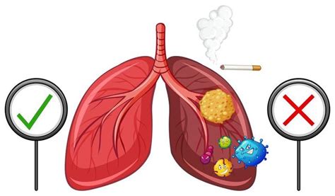 Diagram showing healthy and unhealthy lungs | Lunges, Vector art, Clip art