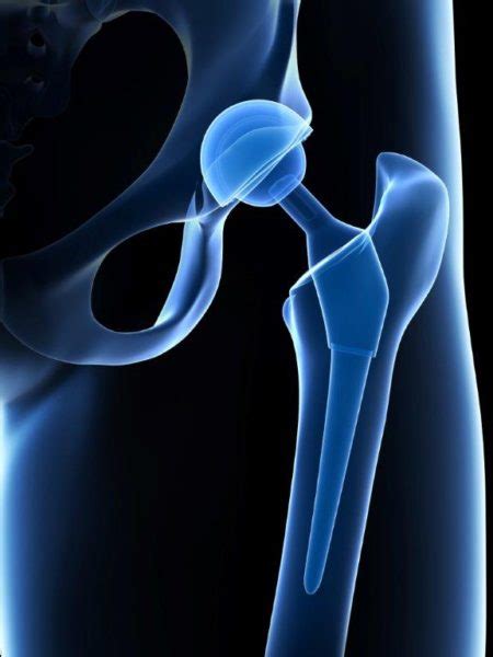 Pending Stryker Hip Replacement Product Recall - Inserra