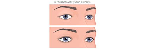 Eyelid Surgery - Canyon Specialty Surgery Center | Weight Loss Surgery | Orthopedic & Spine ...