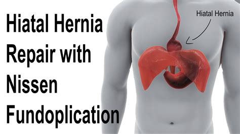 Types Of Hiatal Hernia Surgery