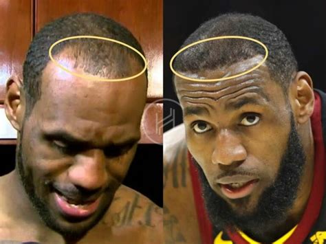 LeBron James Hair Transplant - Hair Loss & Technical Analysis