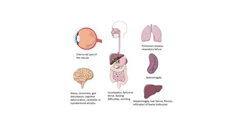 Niemann-Pick Disease - IAS EXAM