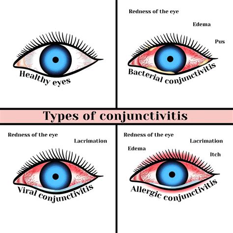 Red Eyes Ear Infection at Diana Rankin blog