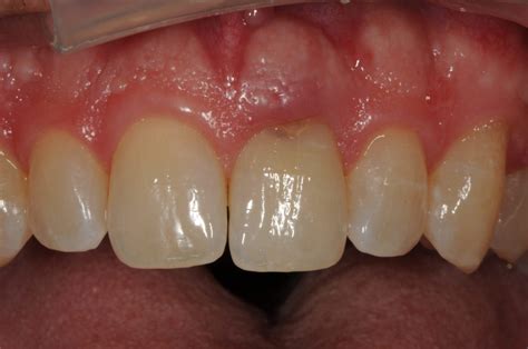 tooth root resorption Archives - Dr Gennero