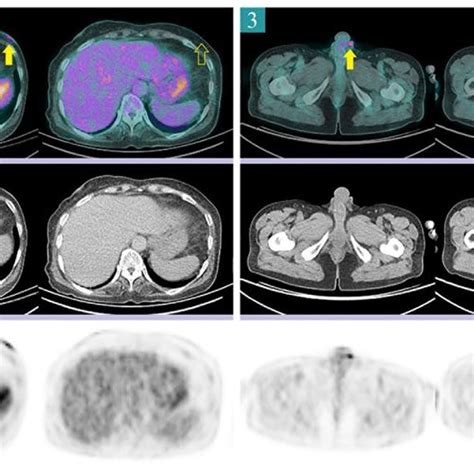 Eschar lesions from 4 patients. Before antibiotic treatment (each left... | Download Scientific ...