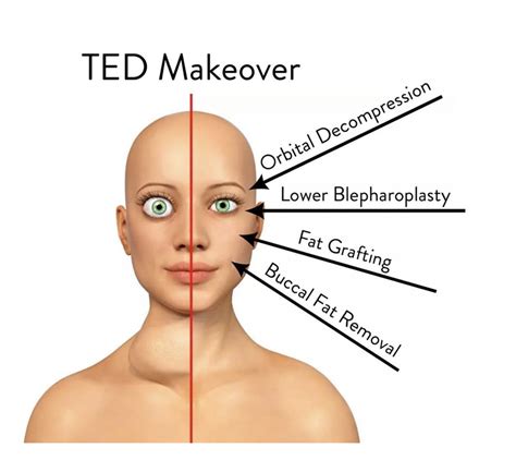 Thyroid Eye Disease Surgery - Thyroid Eyes Treatment