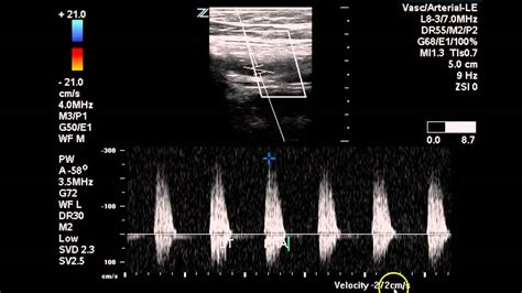 Arterial Doppler Lower Extremity Results