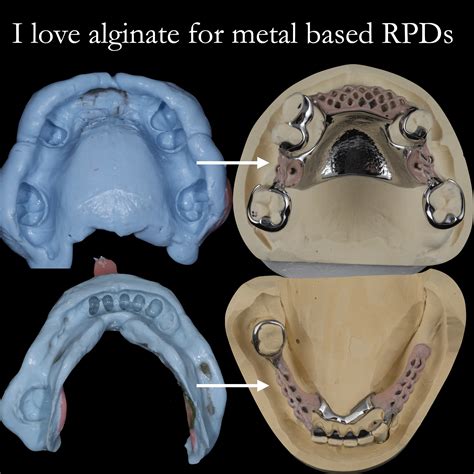 Alginate impression material for metal-based dentures | Finlay Sutton - Denture Education