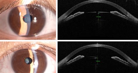 Anterior Segment OCT : Ahalia Eye Care